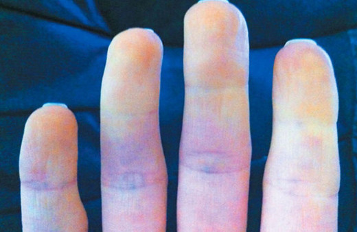 Elleri üşüyenler dikkat! Bu hastalıkların habercisi olabilir