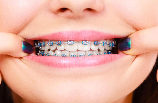 Çarpık dişler için telsiz çözüm