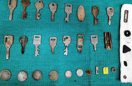 Doktorlar inanamadı midesinden tam 40 tane metal çıktı