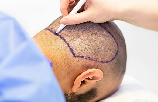 Saç ekimi yapacaklar dikkat! Bu 4 aşamayı dikkate almazsanız...