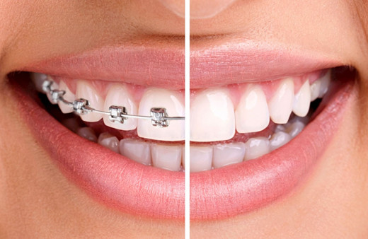 Çarpık dişlere telsiz çözüm nasıl olur İşte cevabı...