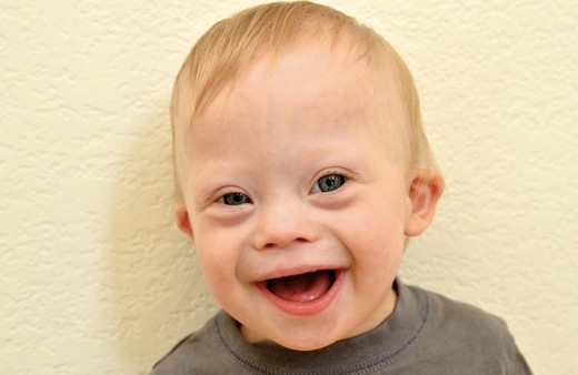 Down Sendromu nedir belirtileri ve kromozom farkı nasıl anlaşılır?