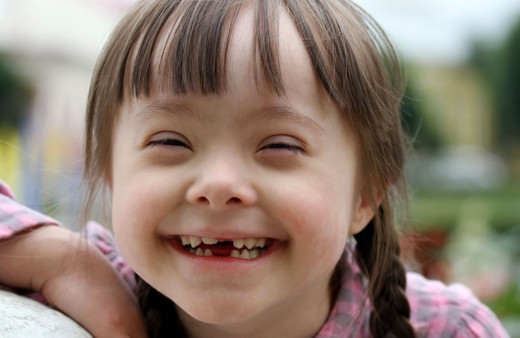 Down sendromunun belirtileri nelerdir kromozom analizi nasıl yapılır?