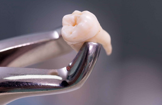 20'lik diş çekilmeli mi uzmanından uyarı geldi