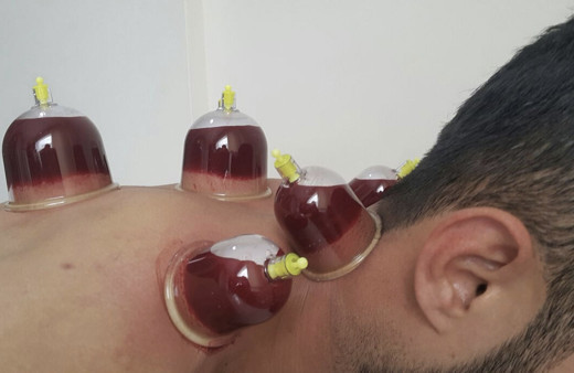 Hacamat günleri 2022 mayıs ayı hacamat günleri takvimi