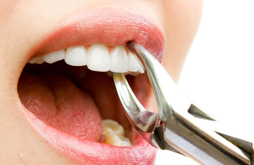 20 yaş dişleri nasıl çekilir ağızdaki en büyük tehlike