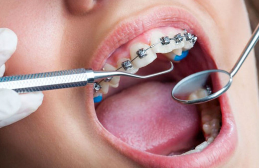 Diş teli ağızda ne kadar kalır işte yapılması gerekenler