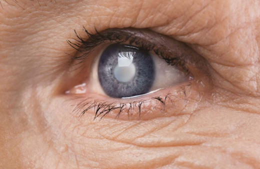 Uzmanlar önerdi kataraktın tedavisi 15-20 dakika sürüyor