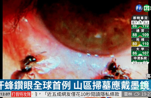 Genç kadının sol gözünden arı çıktı!