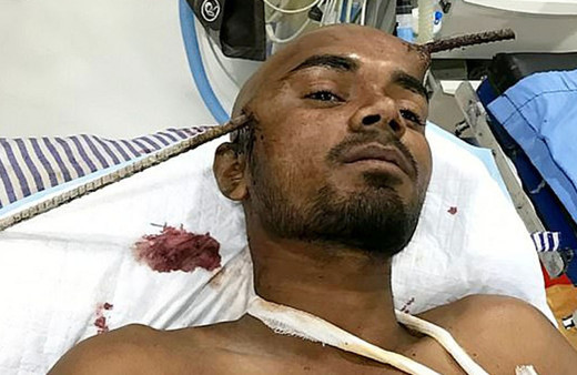 İşçinin başına demir saplandı! Doktorlar onu sağ görünce şaşırdı