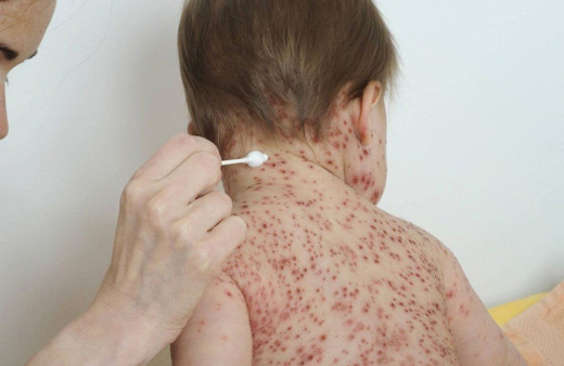 Hastalığın şakası yok! Kızamıktan korunmak için aşı şart!