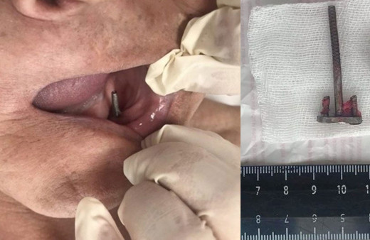 İmplant yerine sanayi tipi vida takmışlar! 28 yıl sonra öğrendi