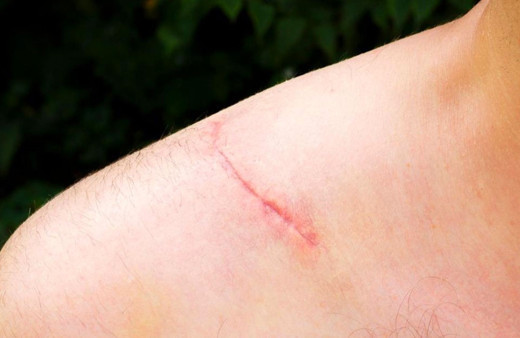 Yara izleri tamamen yok edilebilir mi uzmanlar kesin bir dille uyardı