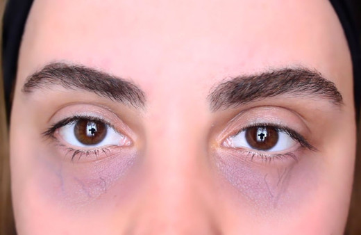 Göz altı morlukları nasıl geçer işte tek seanslık tedavisi