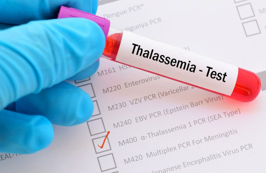 Talasemi (Akdeniz anemisi) nedir tedavi yöntemi nelerdir?