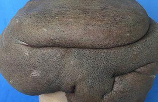 15 kiloluk tümör tüm sırtını sardı!