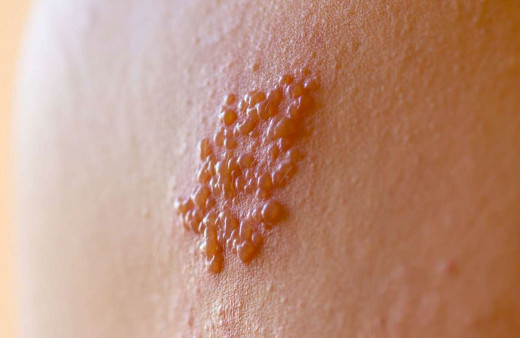 Zona nedir? Kalp krizi ve apandist ile karıştırılıyor