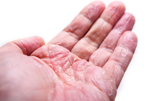 Demir eksikliğinin dikkat etmeniz gereken nedenleri ve belirtileri