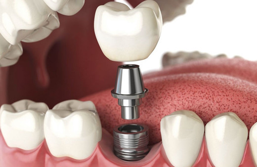 İmplant tedavisi sonrası dikkat edilmesi gerekenler