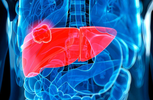 Karaciğer kanseri nedenleri ve dikkat edilmesi gerekenler