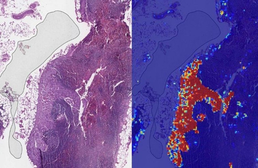 Google, yapay zeka ile akciğer kanserini erken teşhis edebilecek