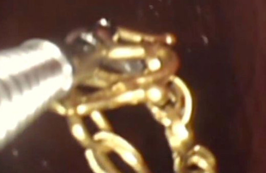 Midesinden çıkan mücevheri doktorları şoke etti