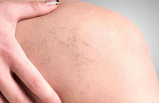 Varis nasıl tedavi edilir Varis hastalığı estetikle geçer mi?