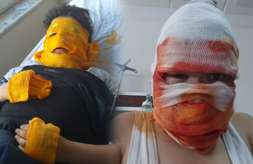 Sprey boya kutusu yüzünde patlamıştı işte 11 yaşındaki çocuğun son hali