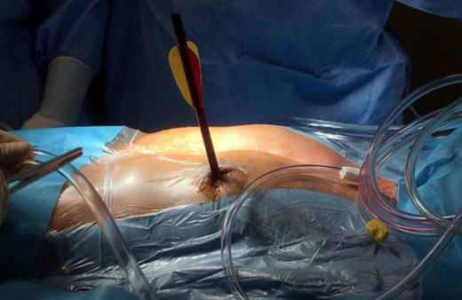 Kalbine saplanan 30 santimlik okla hastaneye geldi