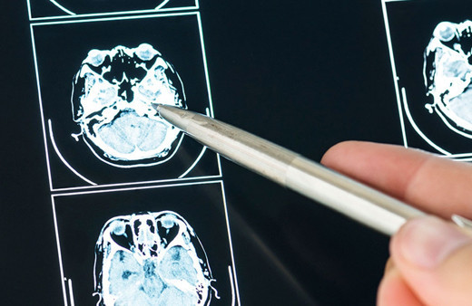 MS hastalığı nedir bakın kimlerde daha çok görülüyormuş