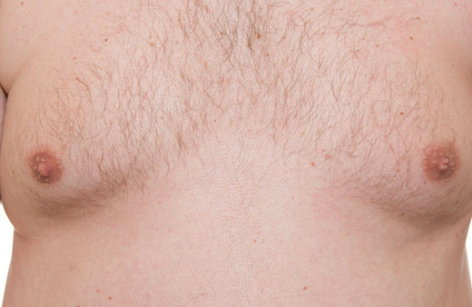 Erkeklerde meme büyümesi neden olur tedavisi nasıldır?