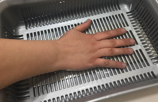 Bölgesel terlemenin tedavisi nasıl olur? El ve ayak terlemesine son