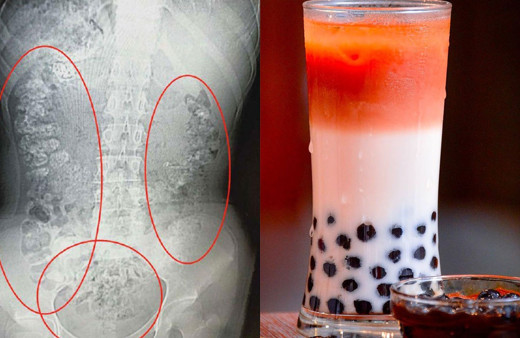 Kabızlık şikayetiyle gitti! Midesinde 100 tane bakın ne bulundu