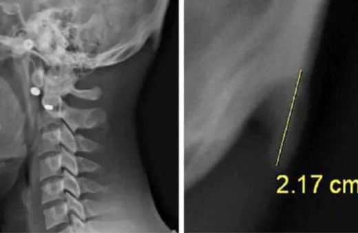 Aşırı cep telefonu kullanımı boynuz çıkıyor!