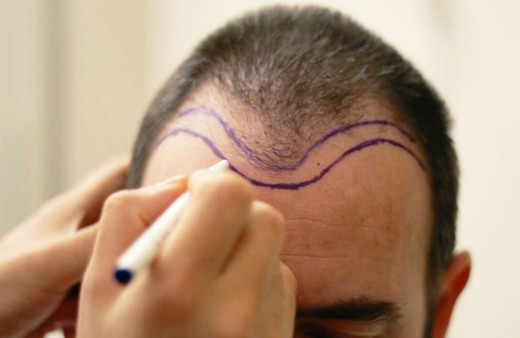 Saç ekimi yaptıranlar denize girebilir mi? Uzmanlar uyardı