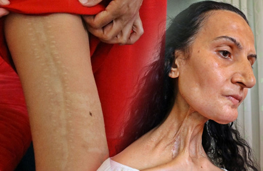 Dil kanserine yakalandı, bacağından parça alıp yeni dil yapıldı