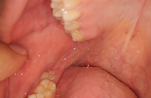 20 yaş dişleri çekilmeli mi? Diş hekiminden önemli açıklamalar