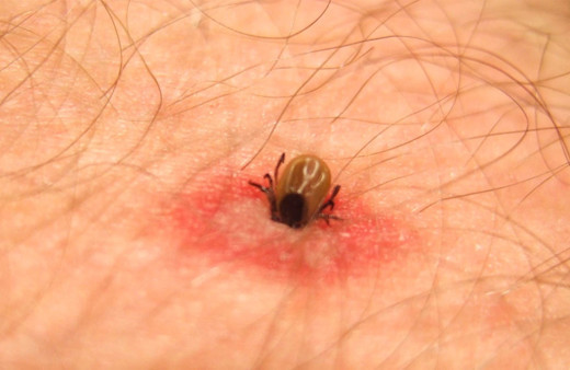 Vücuduna yapışan keneyi kendi çıkaran çoban, öldü