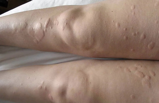 Ayakta kırmızı lekeler neden olur hastalık belirtisi mi?