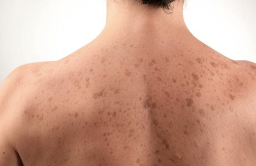 Vücutta lekeler neden olur-kırmızı leke neyin belirtisi?