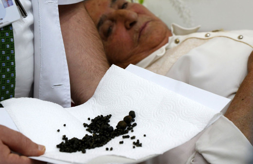 Yaşlı kadının safra kesesinden 450 tane taş çıktı