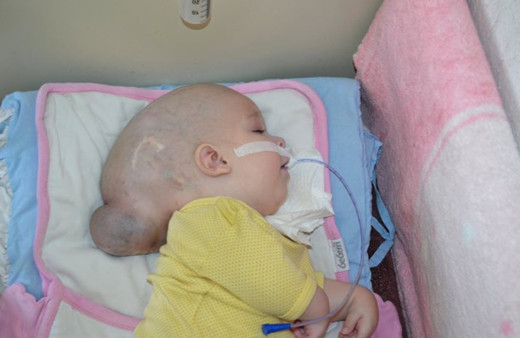 12 aylık bebeği görenler şoke oluyor! Beyni kafatasının dışında büyüyor