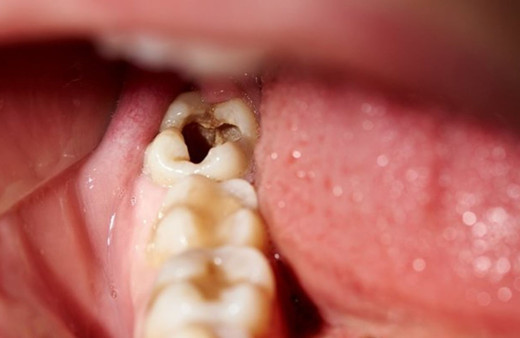 Bu hareketten vazgeçin! Aman dikkat tüm dişleri çürütüyor