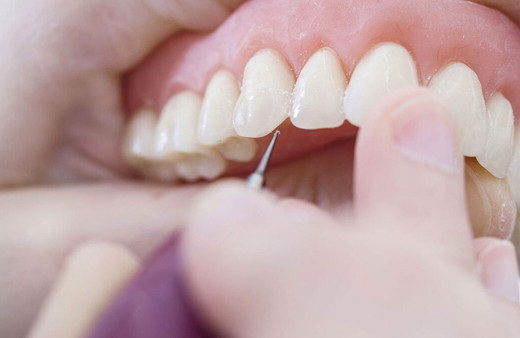 Tansiyon hastaları dikkat! Diş problemleri hakkında önemli uyarılar