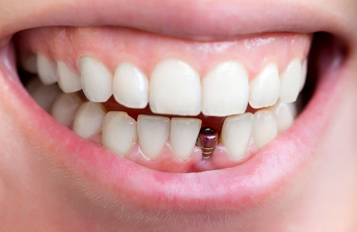 Uzman uyardı! Diş sağlığında kemik kaybı oluşmadan implant yapılmalı