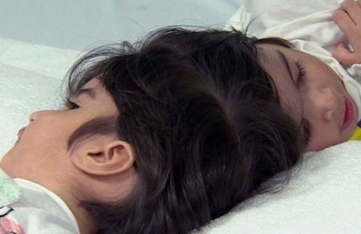 Dünya bu ameliyatı konuşuyor 100 doktor girdi 50 saatte yapışık ikizler birbirinden ayrıldı