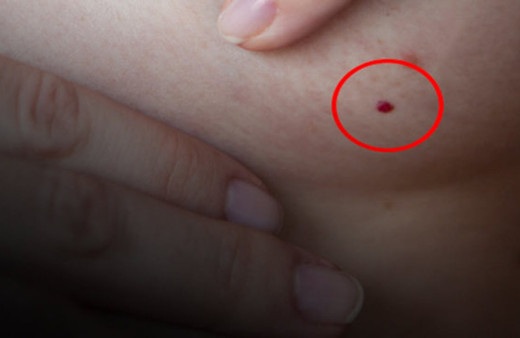 Vücuttaki kırmızı lekeler ne anlama gelir, kanser habercisi mi?