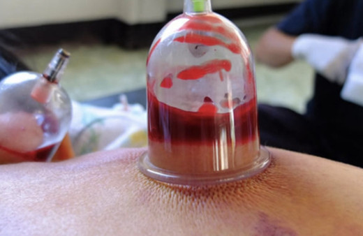 Ekim ayında hacamat hangi günler yapılır ne zaman yapılmaz