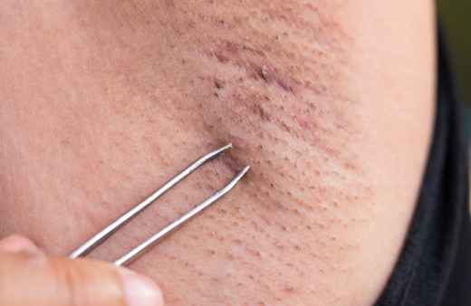 Mucize doğal yöntem! Koltuk altı tüylerinden kurtulmanın doğal yolu