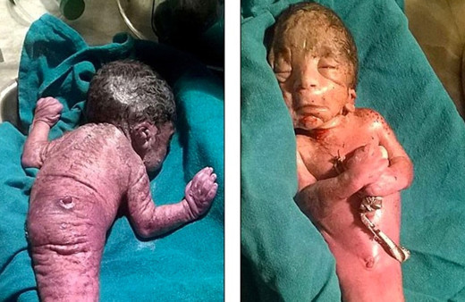 Hindistan’da denizkızı sendromlu bebek dünyaya geldi